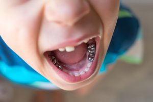 how dental crowns restore damaged or weak teeth