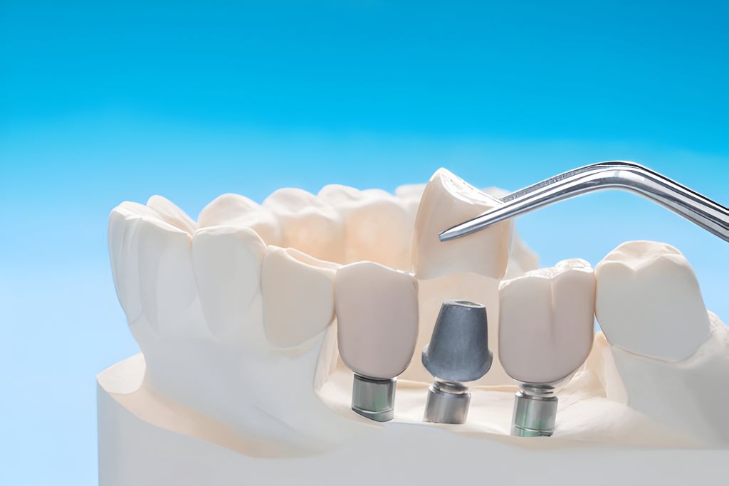 dental crowns in south edmonton