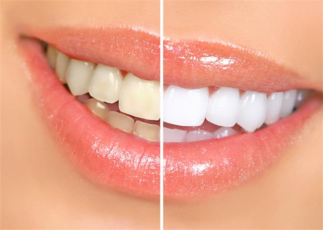 teeth whitening treatment south edmonton