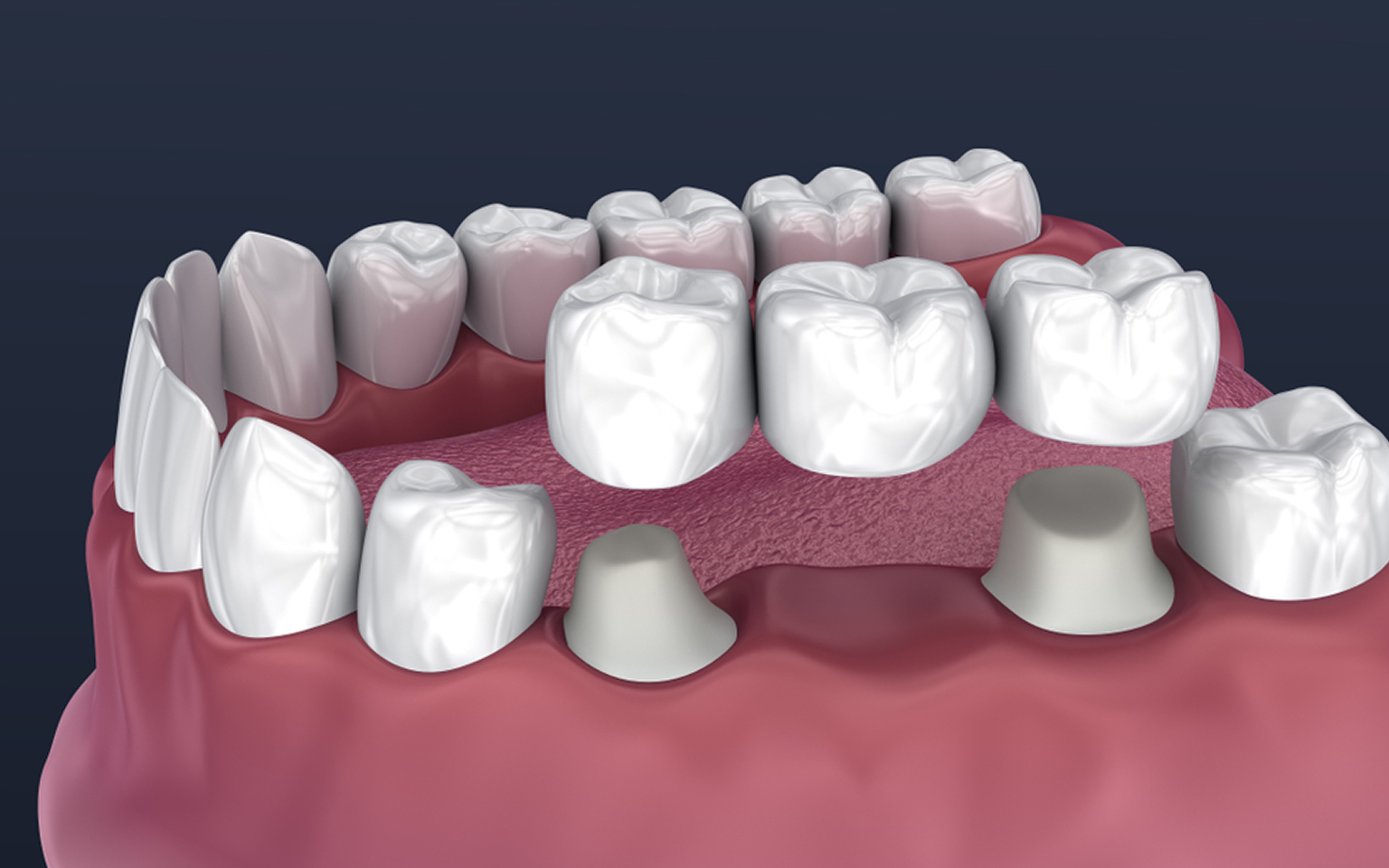 dental bridges in south edmonton