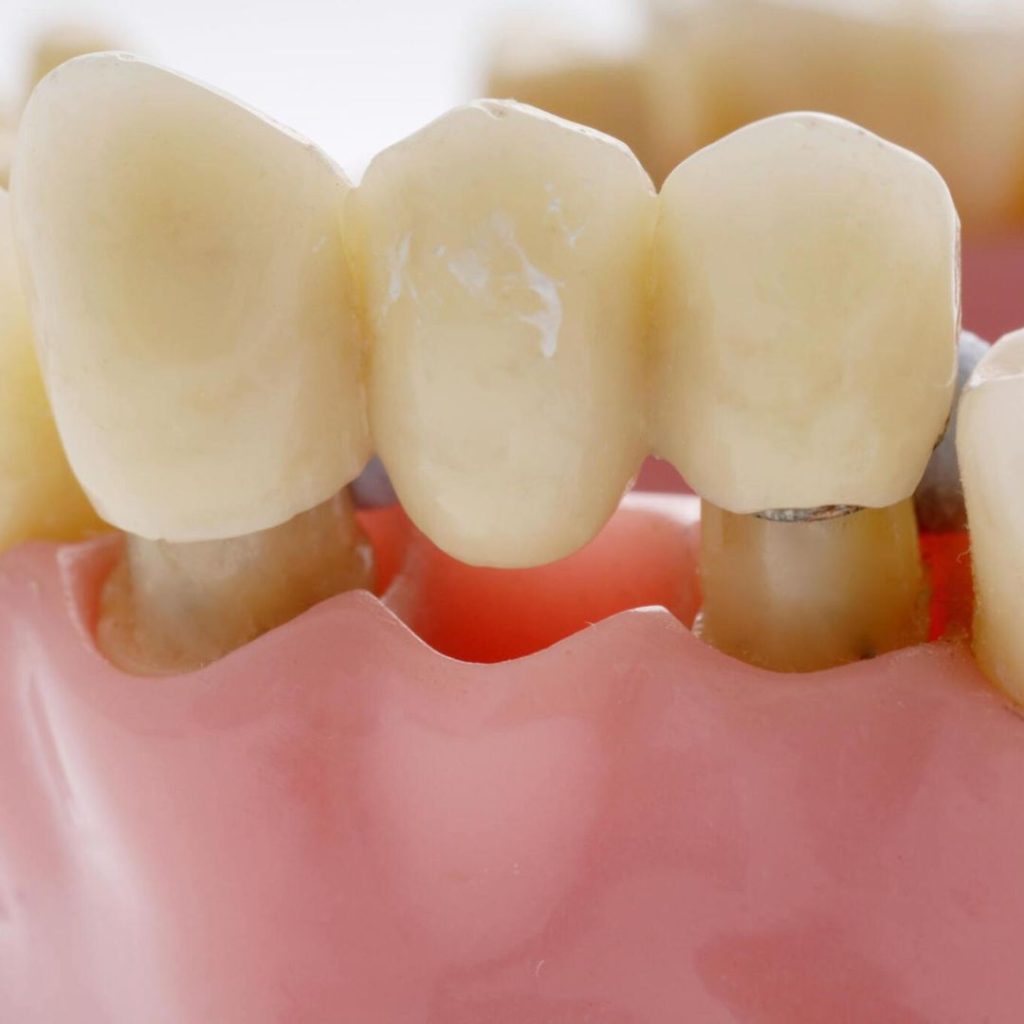 dental bridges near you