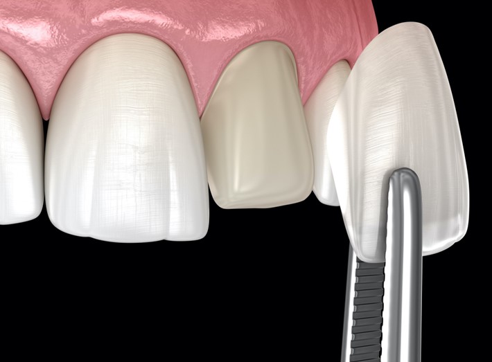 dental veneers near you in south edmonton