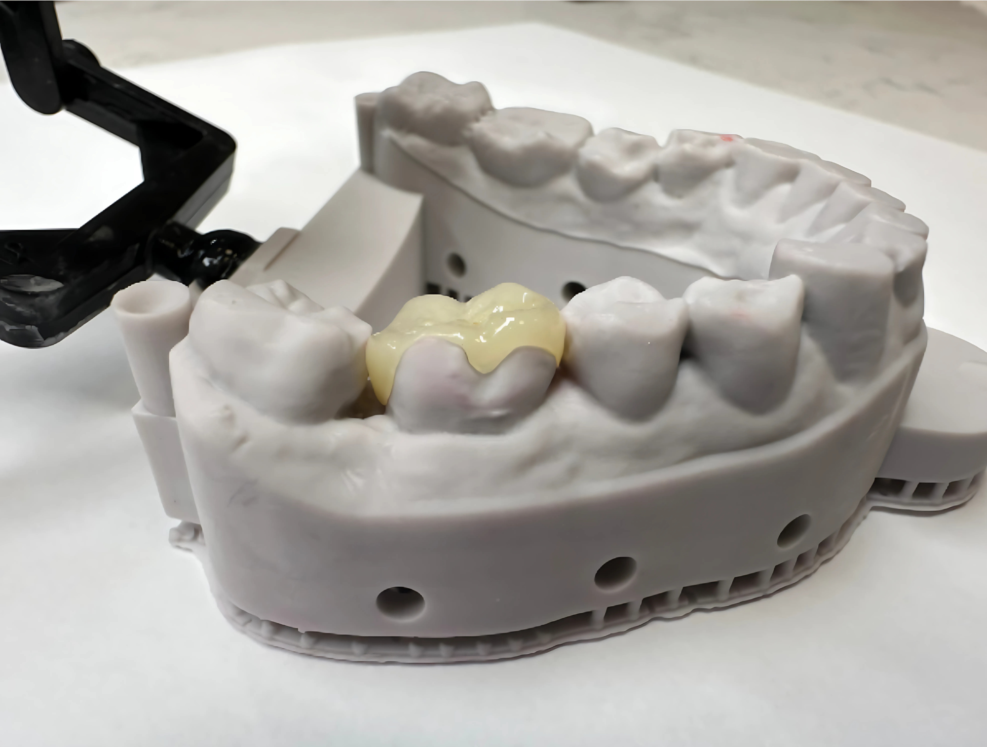 inlays and onlays service at ace dental studio