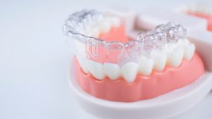 what to know about invisalign and its effectiveness
